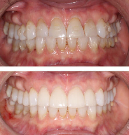 Case 1 before and after cosmetic dentistry at Montana Dental Works