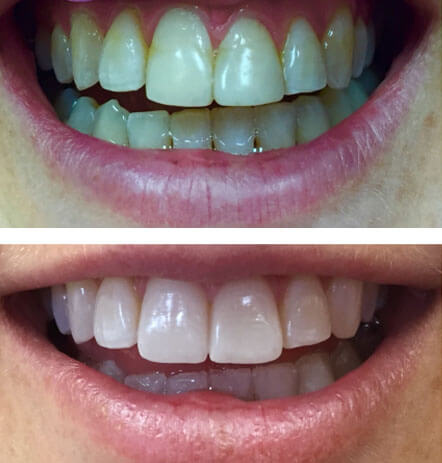 Case 2 before and after cosmetic dentistry at Montana Dental Works