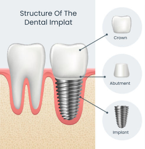 Structure of a dental implant showing the implant in the jaw with abutment and crown attached