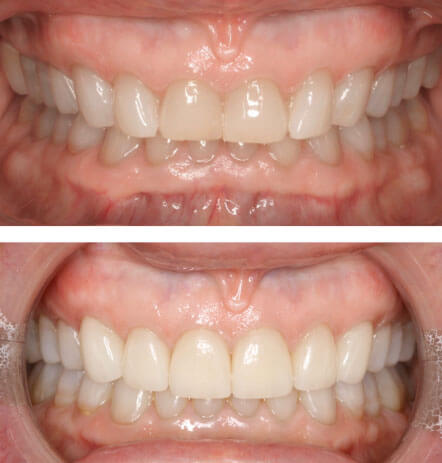 Case 3 before and after cosmetic dentistry at Montana Dental Works