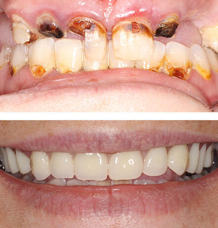 Before and after pictures of restoring a patient's teeth