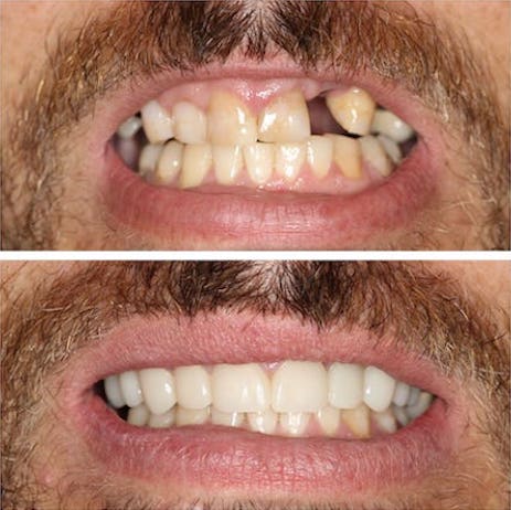 Before and after of smile restoration