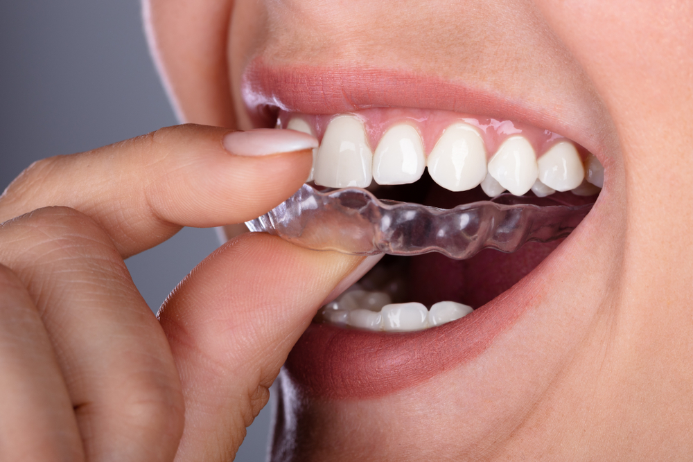 A woman putting in her clear aligners, a cosmetic dentistry treatment.